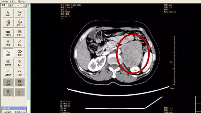 CT影像肾上腺区占位,警惕嗜铬细胞瘤